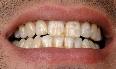 Unhealthy teeth